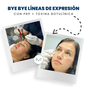 BYE BYE LÍNEAS DE EXPRESIÓN