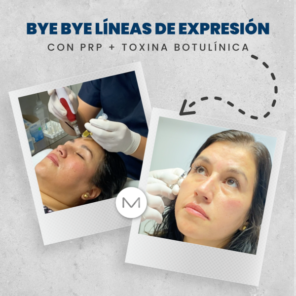 BYE BYE LÍNEAS DE EXPRESION