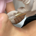 PRP EN CUELLO, ESCOTE Y MANOS